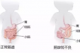健康科普 | 宝宝反复呕吐需警惕“肠子兄”在极力旋转自己！